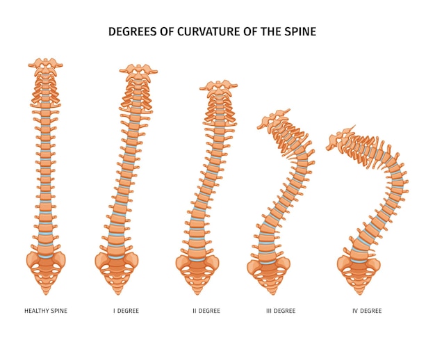 Bezpłatny wektor anatomia struktury kręgosłupa zestaw izolowanych ikon przedstawiających różne stopnie krzywizny kręgosłupa ilustracja wektorowa zdrowych i chorych