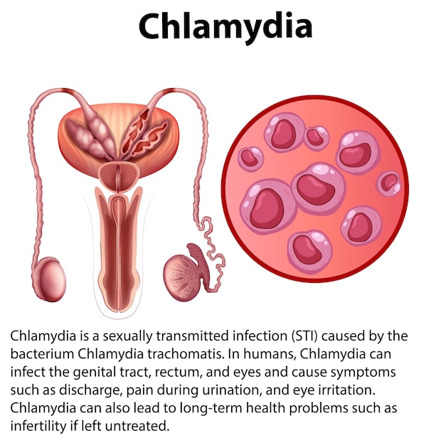 Bezpłatny wektor chlamydia trachomatis z wyjaśnieniem