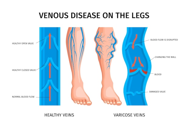 Bezpłatny wektor choroby żylne nóg schemat infografiki przepływu krwi w zdrowych i żylakach realistyczne ilustracji wektorowych