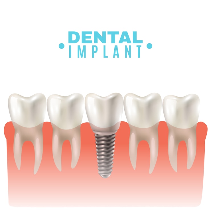 Bezpłatny plik Wektor dental implant model side view poster 