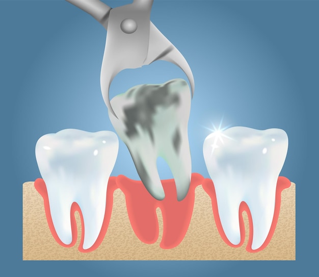 Ekstrakcja zęba wektor szablon projektu medycznego plakatu