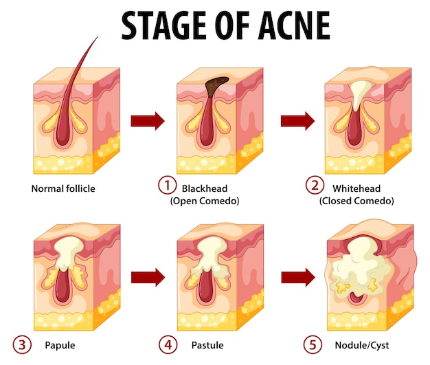 Bezpłatny wektor etapy anatomii trądziku skóry