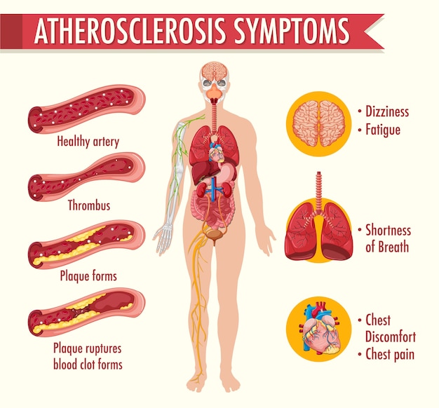 Etapy Infografiki Informacji Miażdżycy