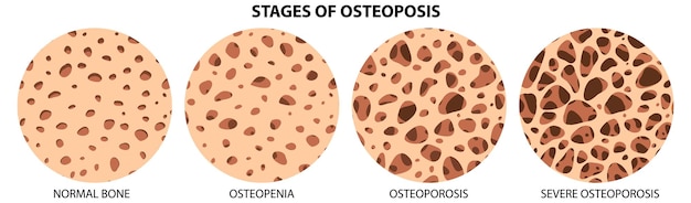 Bezpłatny wektor etapy wektora osteoporozy