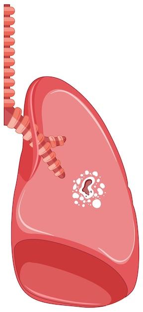 Bezpłatny wektor gruźlica w ludzkim ciele