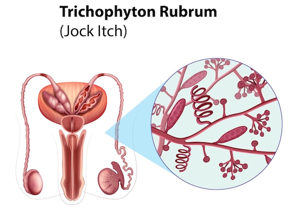 Infekcja Grzybicza Trichophyton Rubrum