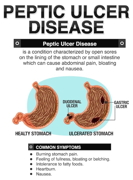 Bezpłatny wektor infografika choroby wrzodowej
