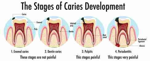 Bezpłatny wektor infografika człowieka na etapach rozwoju próchnicy