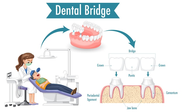 Infografika Człowieka W Moście Dentystycznym Na Białym Tle