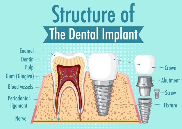 Infografika człowieka w strukturze implantu zębowego