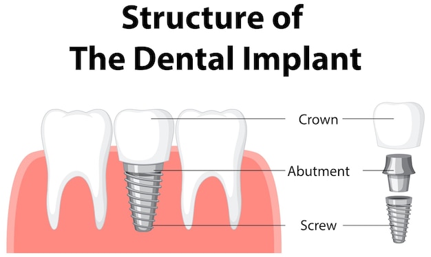 Infografika człowieka w strukturze implantu zębowego