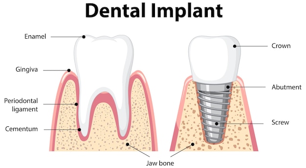 Bezpłatny wektor infografika człowieka w strukturze implantu zębowego