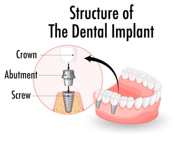 Infografika Człowieka W Strukturze Implantu Zębowego