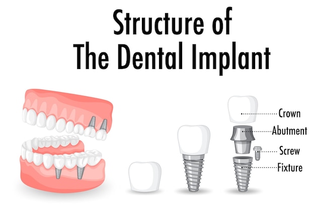 Infografika Człowieka W Strukturze Implantu Zębowego