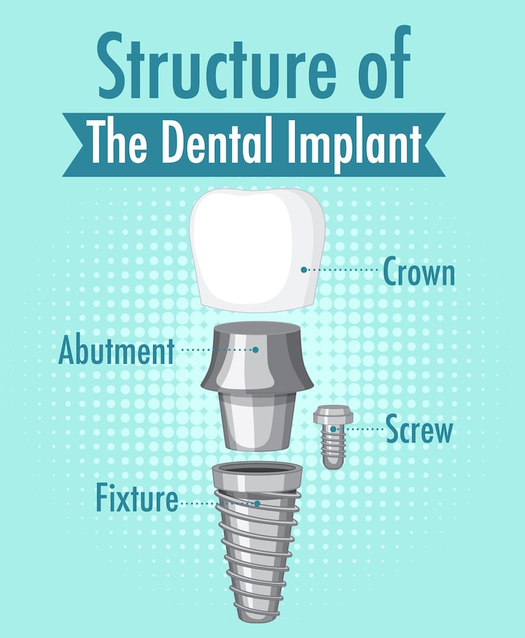Bezpłatny plik Wektor infografika człowieka w strukturze implantu zębowego