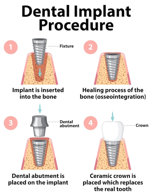 Bezpłatny wektor infografika człowieka w strukturze implantu zębowego