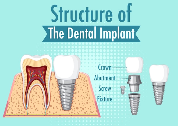 Infografika człowieka w strukturze implantu zębowego
