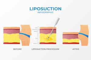 Bezpłatny wektor infografika gradientowej liposukcji