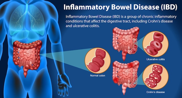 Bezpłatny wektor nieswoiste zapalenie jelit ibd infografika