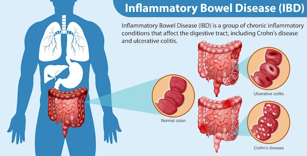 Nieswoiste Zapalenie Jelit Ibd Infografika