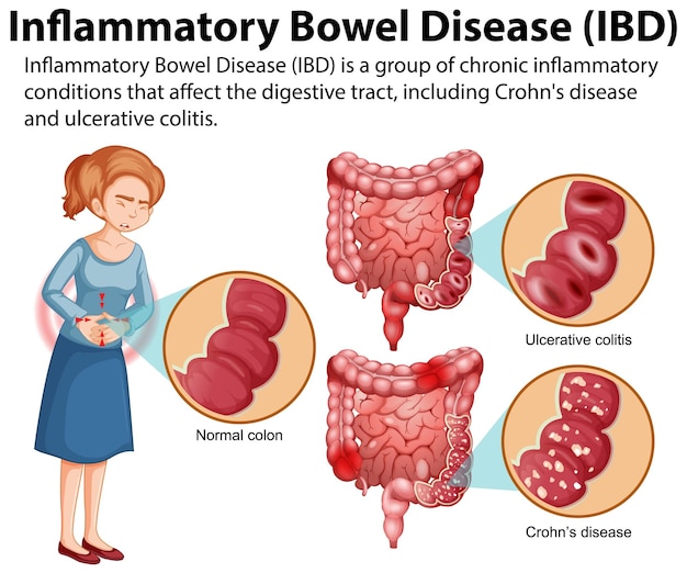 Bezpłatny wektor nieswoiste zapalenie jelit ibd infografika