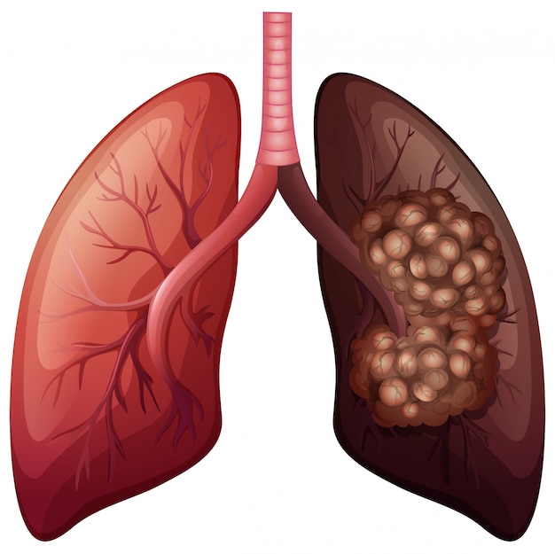 Normalny rak płuc i płuc