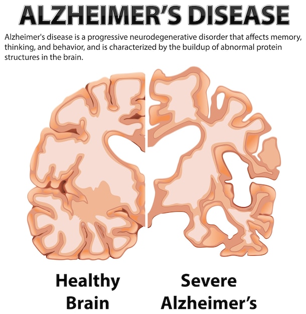 Bezpłatny wektor plakat informacyjny choroby alzheimera