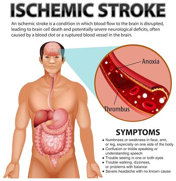 Plakat Informacyjny Udaru Niedokrwiennego