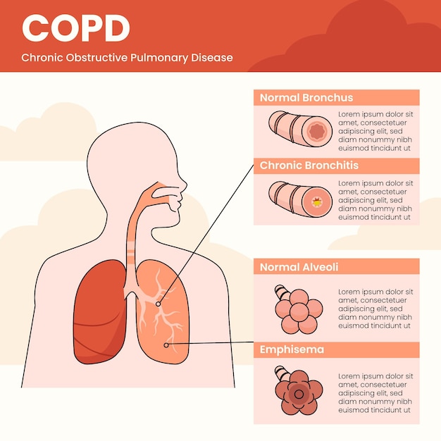 Bezpłatny wektor plansza copd z płaskim ręcznie rysowane