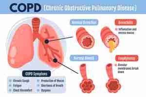 Bezpłatny wektor płaski szablon infografiki copd