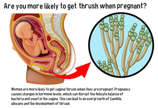 Bezpłatny wektor pleśniawki pochwy podczas ciąży infografika z wyjaśnieniem