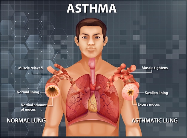 Bezpłatny wektor porównanie zdrowego płuca i płuc z astmą