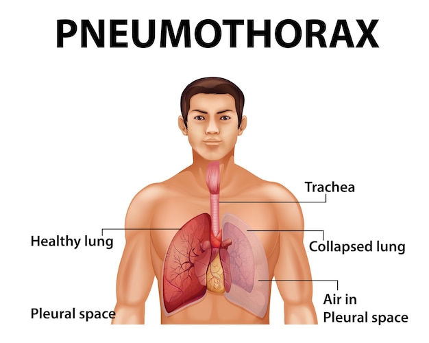 Bezpłatny wektor pouczająca ilustracja odmy opłucnowej