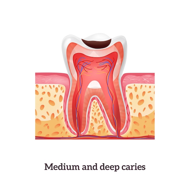 Bezpłatny wektor realistyczna struktura zęba ze średnią i głęboką próchnicą