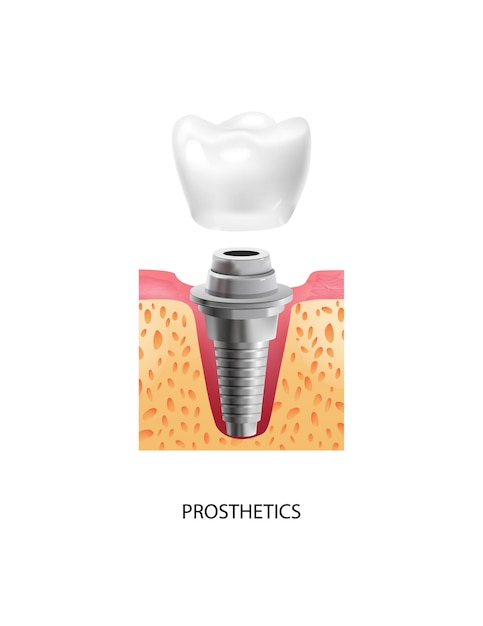 Bezpłatny wektor realistyczny ząb ze składem implantu dentystycznego