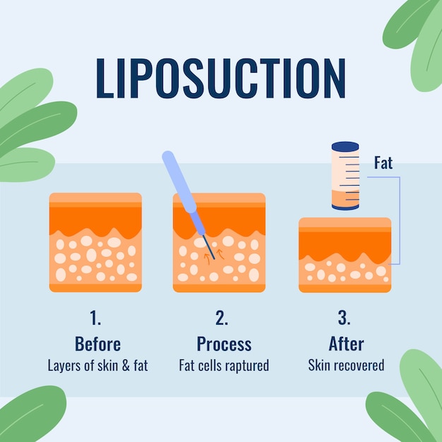 Bezpłatny wektor ręcznie rysowane płaska infografika liposukcji