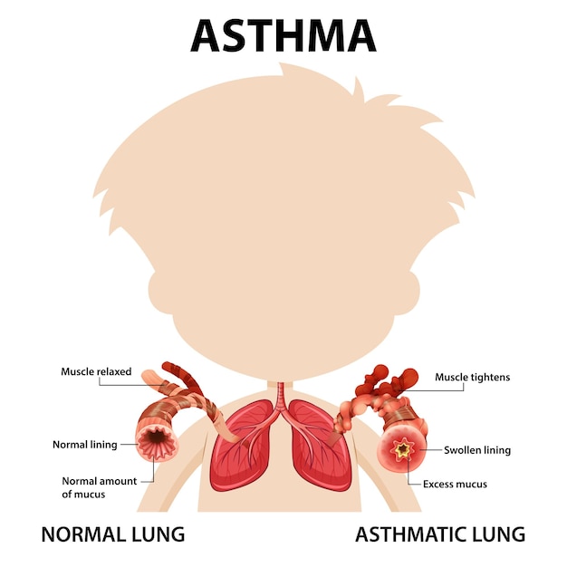 Bezpłatny wektor schemat astmy oskrzelowej z prawidłowym i astmatycznym płucem