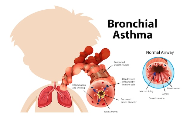 Bezpłatny wektor schemat astmy oskrzelowej z prawidłowymi i astmatycznymi drogami oddechowymi