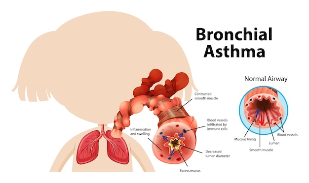Bezpłatny wektor schemat astmy oskrzelowej z prawidłowymi i astmatycznymi drogami oddechowymi