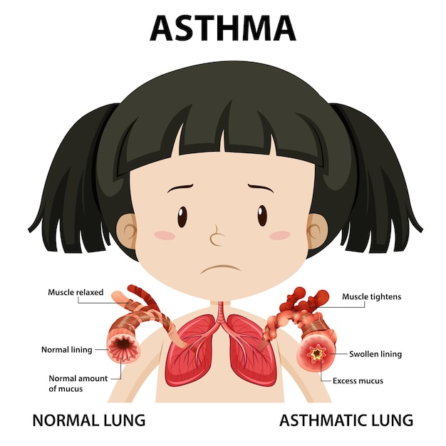 Bezpłatny wektor schemat astmy z prawidłowym i astmatycznym płucem