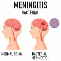 Bezpłatny wektor schemat przedstawiający bakteryjne zapalenie opon mózgowych w mózgu