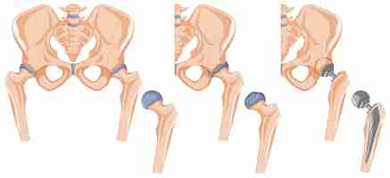 Bezpłatny wektor schemat przedstawiający leczenie kości biodrowej