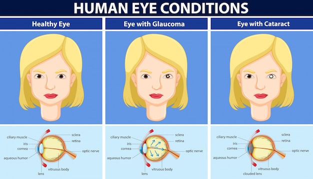 Schemat Przedstawiający Ludzkie Warunki Oczu Premium Wektorów