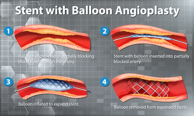 Bezpłatny wektor schemat przedstawiający stent z balonową angioplastyką u człowieka
