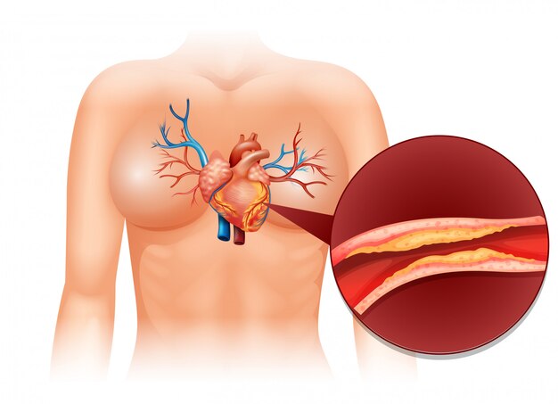 Bezpłatny wektor serce cholesteral u ludzi