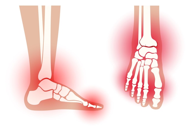 Staw stopy stawów. ból reumatoidalny w płaskiej ilustracji wektorowych nogi