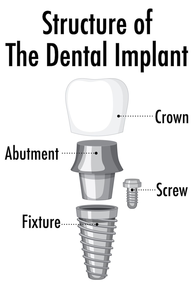 Bezpłatny plik Wektor struktura implantu dentystycznego na białym tle
