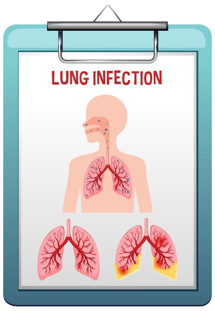 Wektor Zapalenia Płuc Zakażenia Płuc