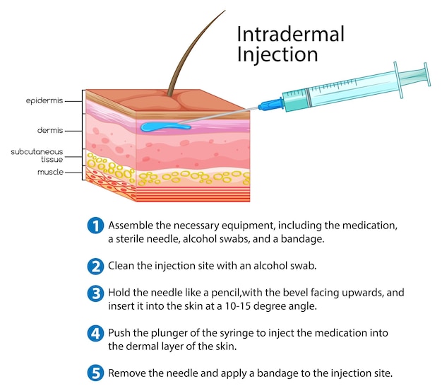 Bezpłatny wektor wstrzyknięcie śródskórne z wyjaśnieniem