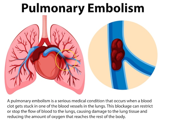 Zatorowość Płucna Z Wyjaśnieniem